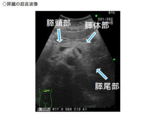 膵臓の検査、エコー