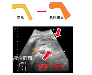 膵臓の検査、エコー
