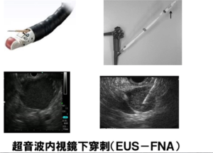 膵臓の超音波内視鏡