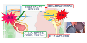 卵円孔の治療について