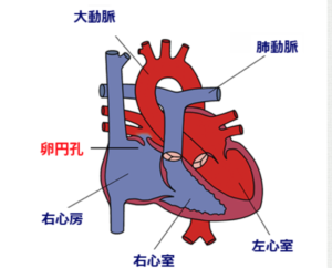 卵円孔の治療について